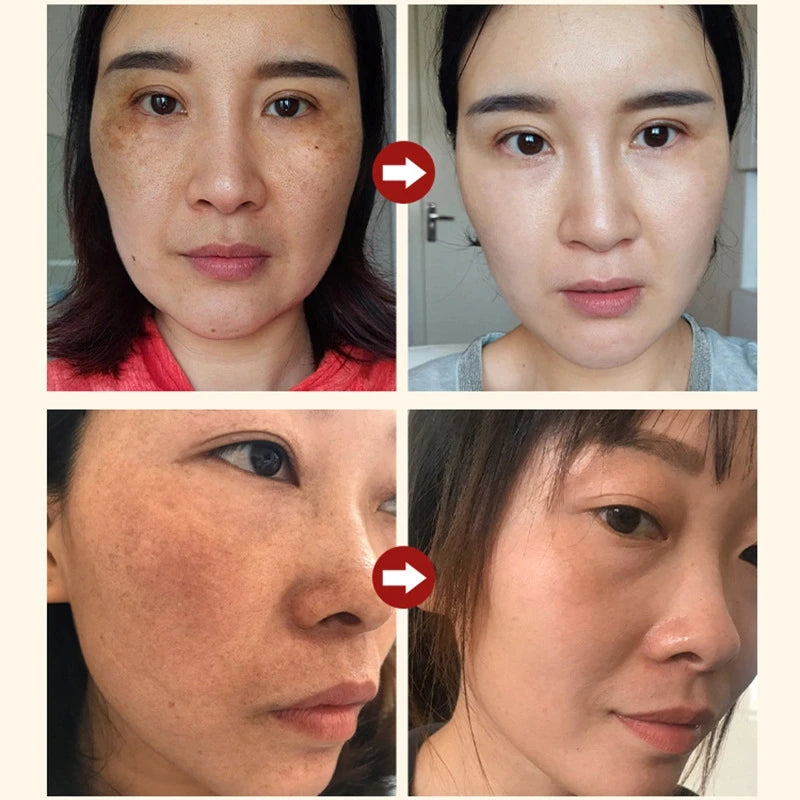 Nicotinamide Attenuates Stains  Facial Essence Salicylic Acid Shrinks Pores Freckle Removal Moisturizes Skin Care Products 2024