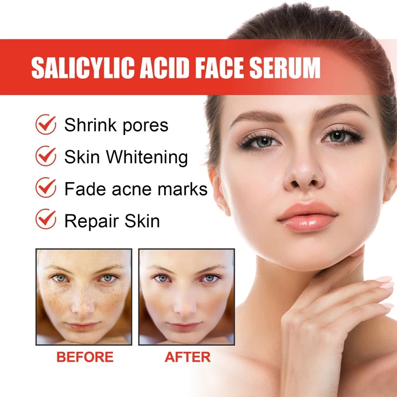 Nicotinamide Attenuates Stains  Facial Essence Salicylic Acid Shrinks Pores Freckle Removal Moisturizes Skin Care Products 2024